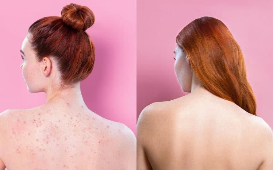 Clarifying back acne control treatment at Mayon Aesthetic Centre