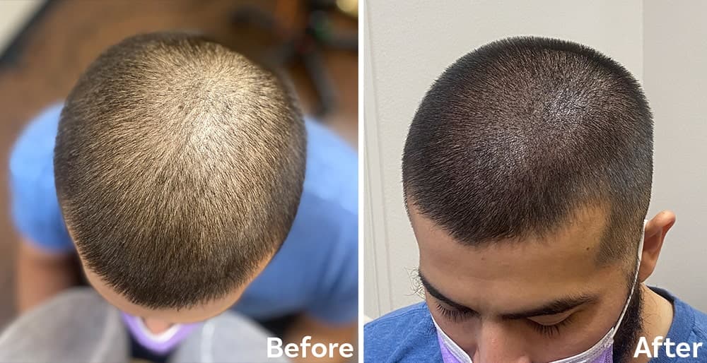 GFC elite growth factor scalp therapy at Mayon Aesthetic Centre