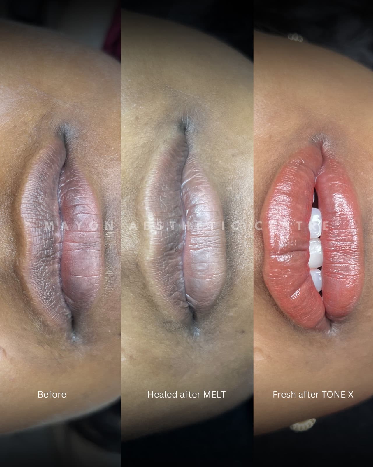 Dark lip neutralization PMU at Mayon Aesthetic Centre