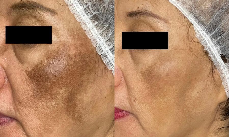 Pico laser pigmentation treatment at Mayon Aesthetic Centre