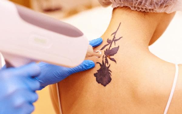 Laser tattoo lightening at Mayon Aesthetic Centre